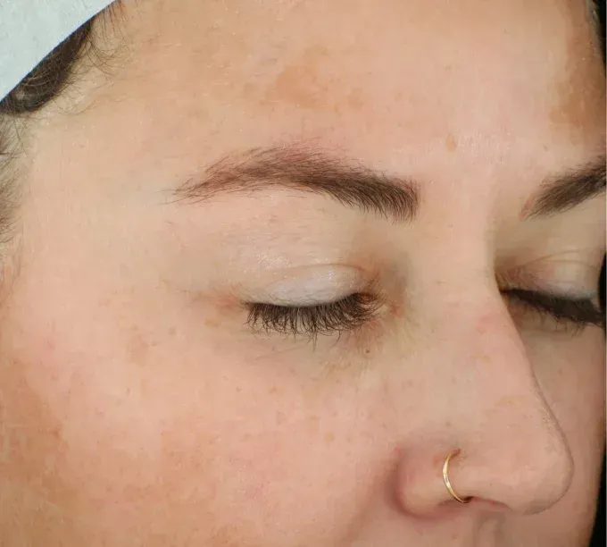 Refreshed and rejuvenated skin after Glacial RX