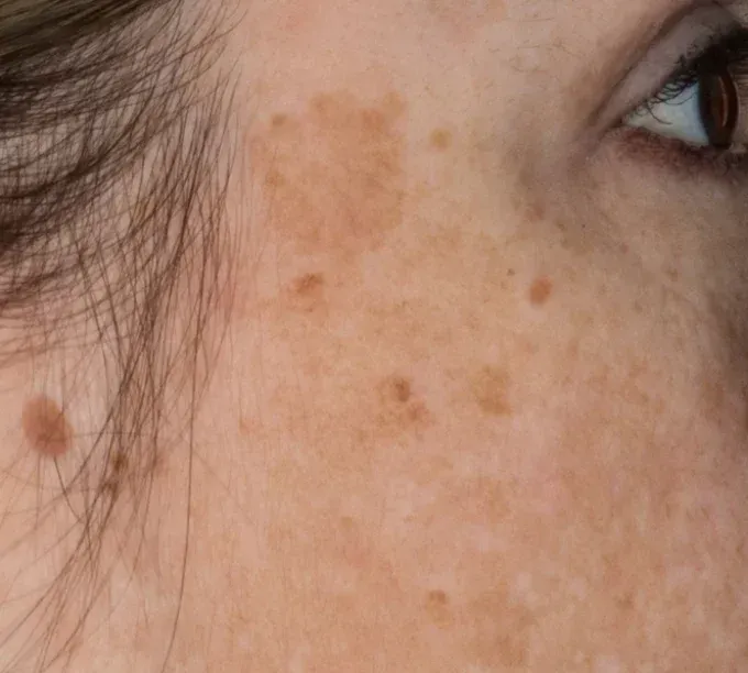 A close up of a woman 's face with freckles before Glacial RX