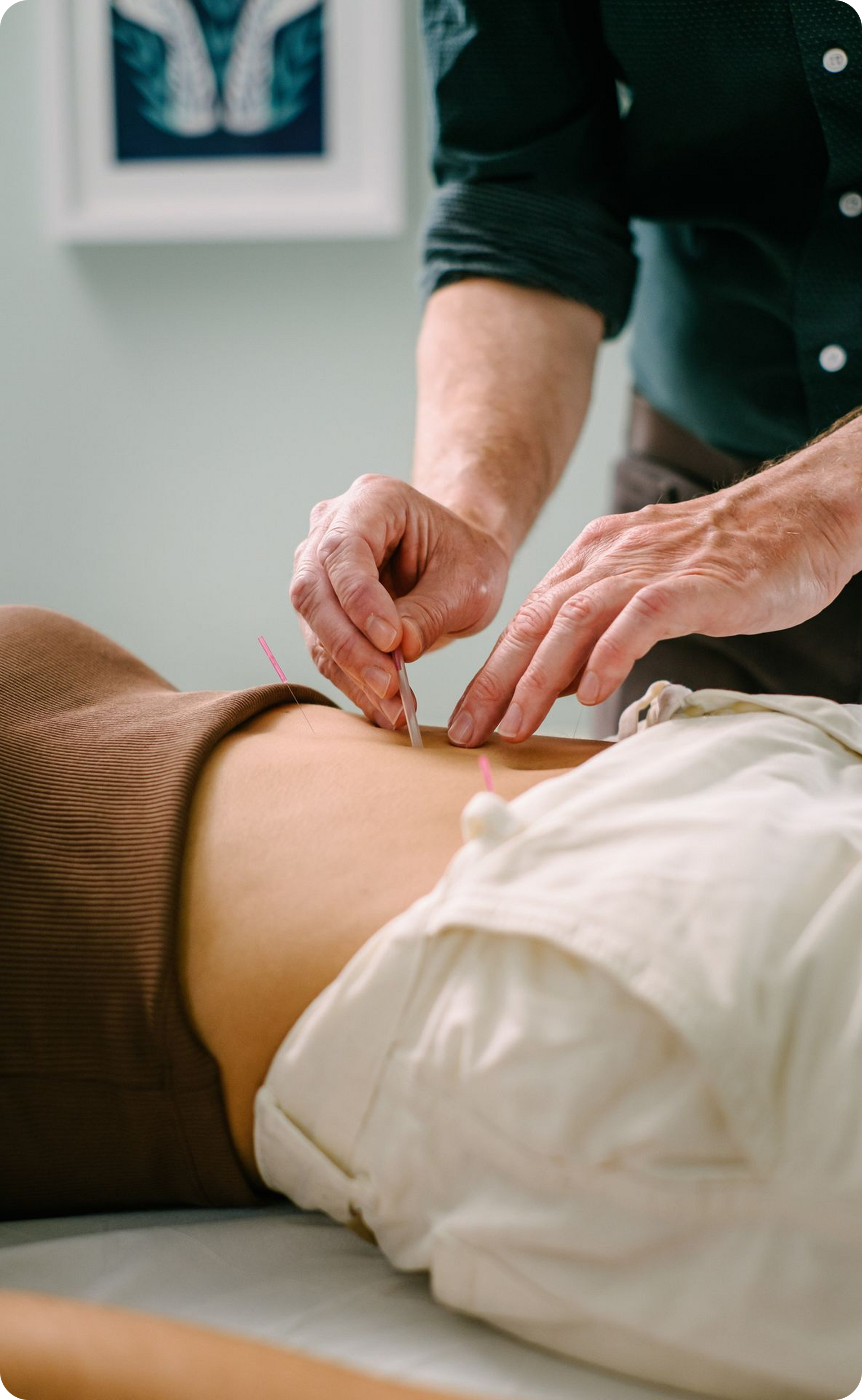 Acupuncturist inserting needles into a person's back, in a light-colored room.
