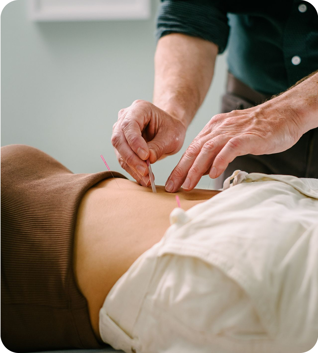 Close-up of an acupuncturist inserting thin needles into a person’s abdomen during an acupuncture treatment.