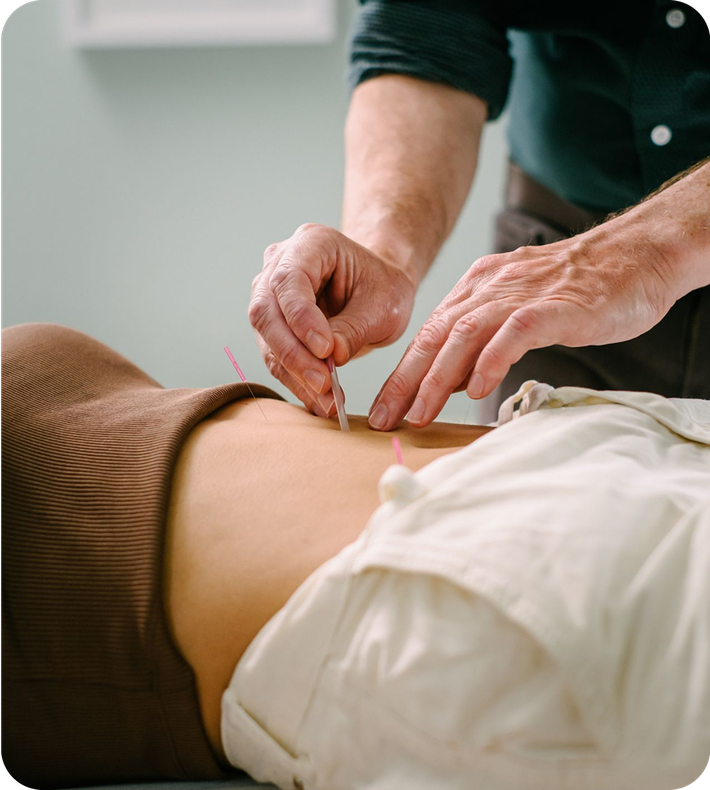 Close-up of an acupuncturist inserting thin needles into a person’s abdomen during an acupuncture treatment.