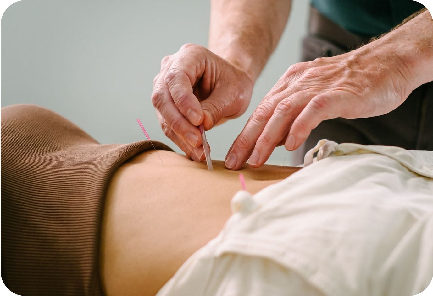 Close-up of an acupuncturist inserting thin needles into a person’s abdomen during an acupuncture treatment.