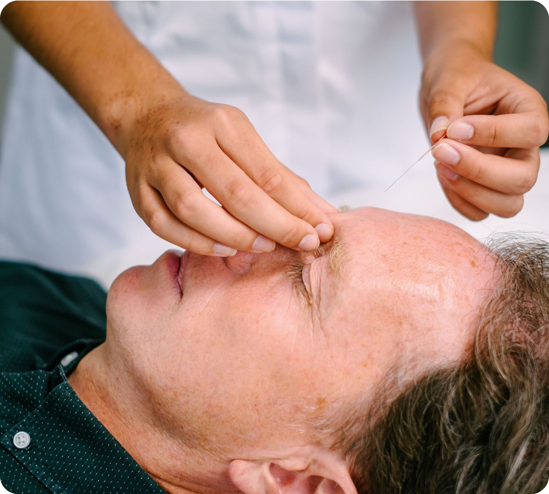 An acupuncturist is placing a thin needle into an extra acupuncture point called Yintang to help calm the mind.