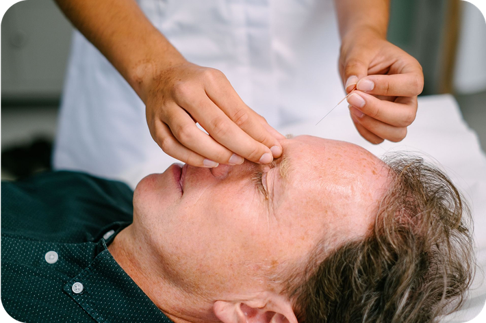 An acupuncturist placing a thin needle into an extra acupuncture point called Yintang to help calm the mind.