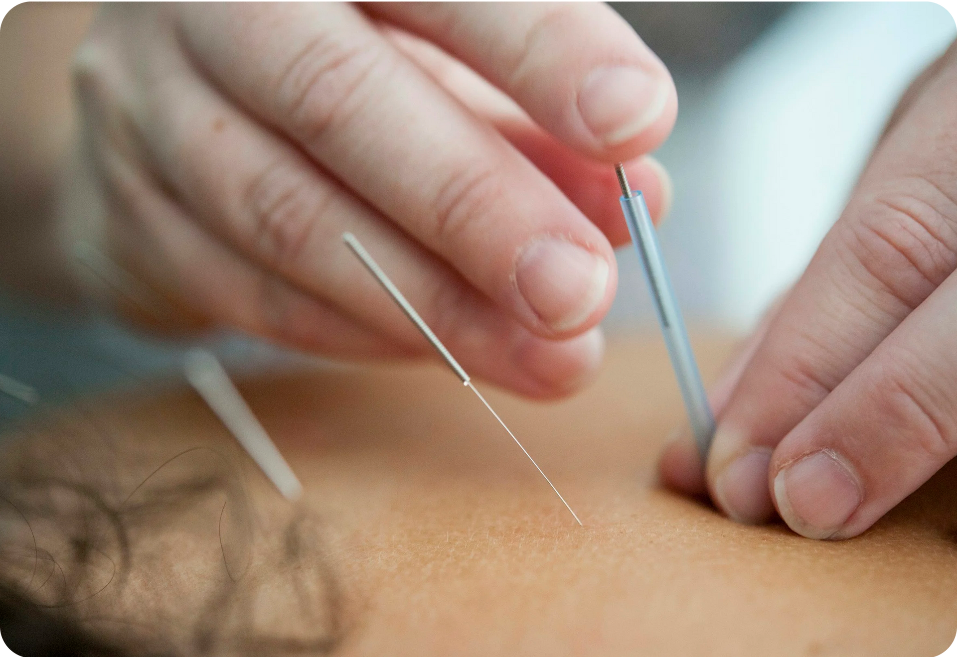 A close-up image of an acupuncturist placing a few needles into the patient's back along the Du Mai channel.