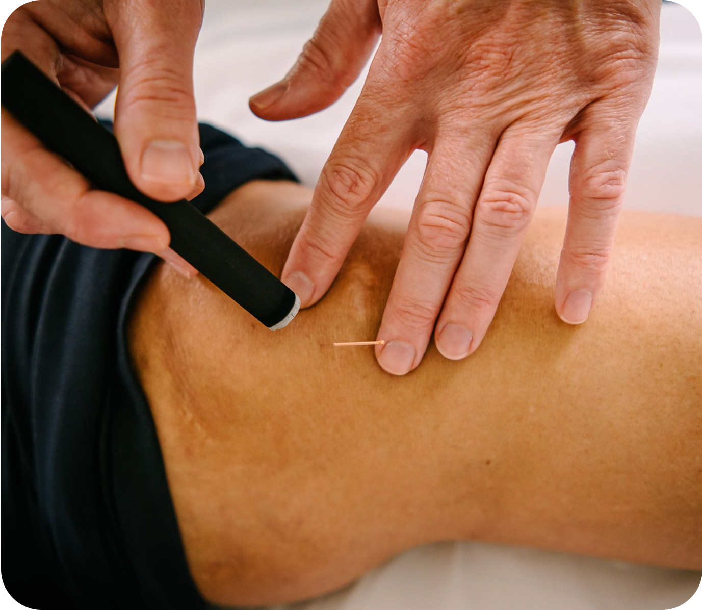 Hands inserting an acupuncture needle into a person's leg, next to a black pen-like device, on a white surface.