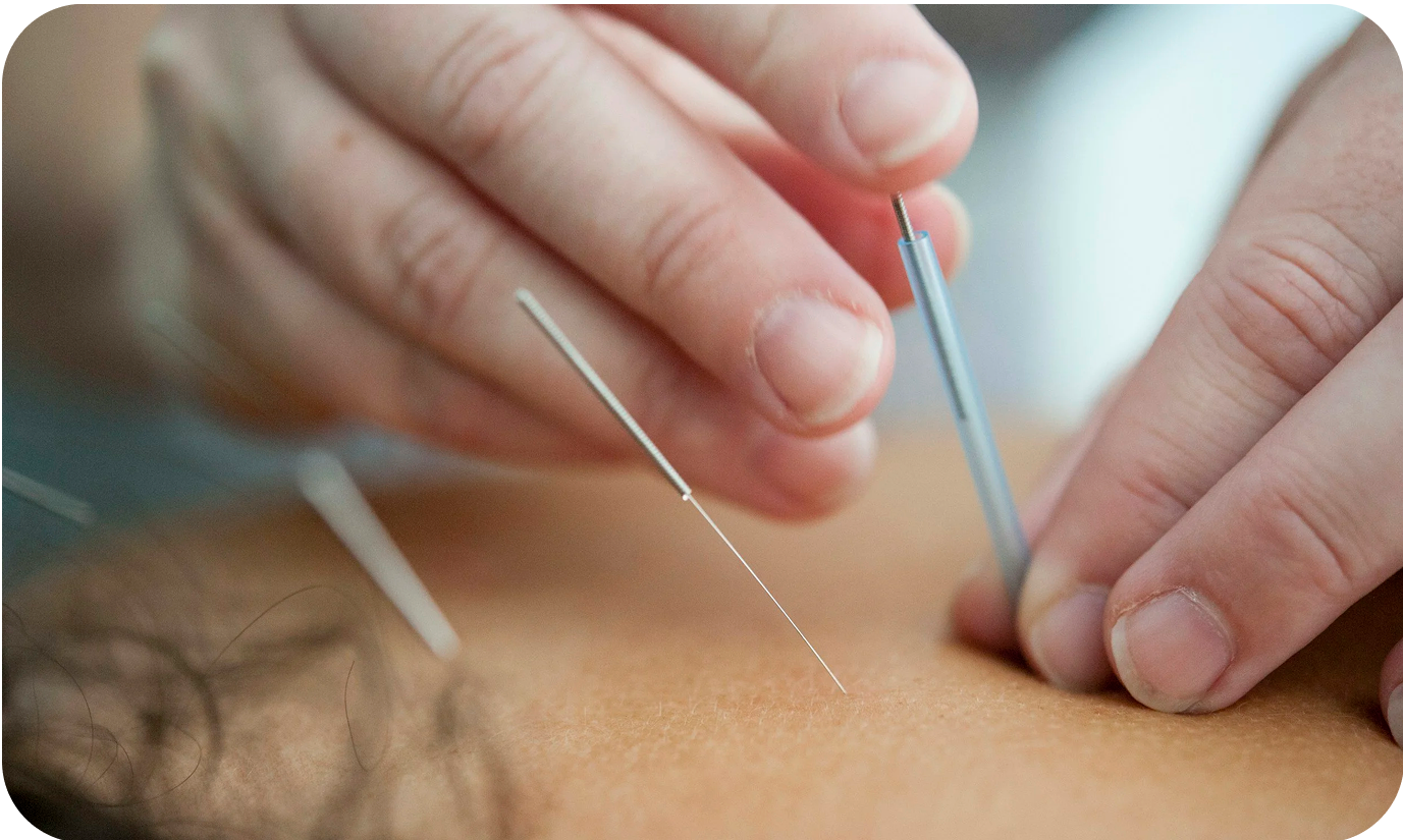A close-up of an acupuncturist needling a point on a patient's upper back with two needles already having been inserted.