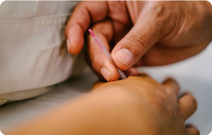 A close-up of an acupuncturist, Josh, needling an acupuncture point called He Gu, also known as Large Intestine 4.