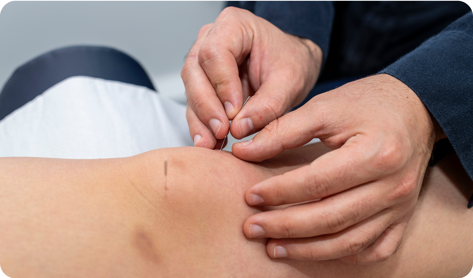 A close-up of an acupuncturist needling a patient's knee whilst they are lying on the couch.