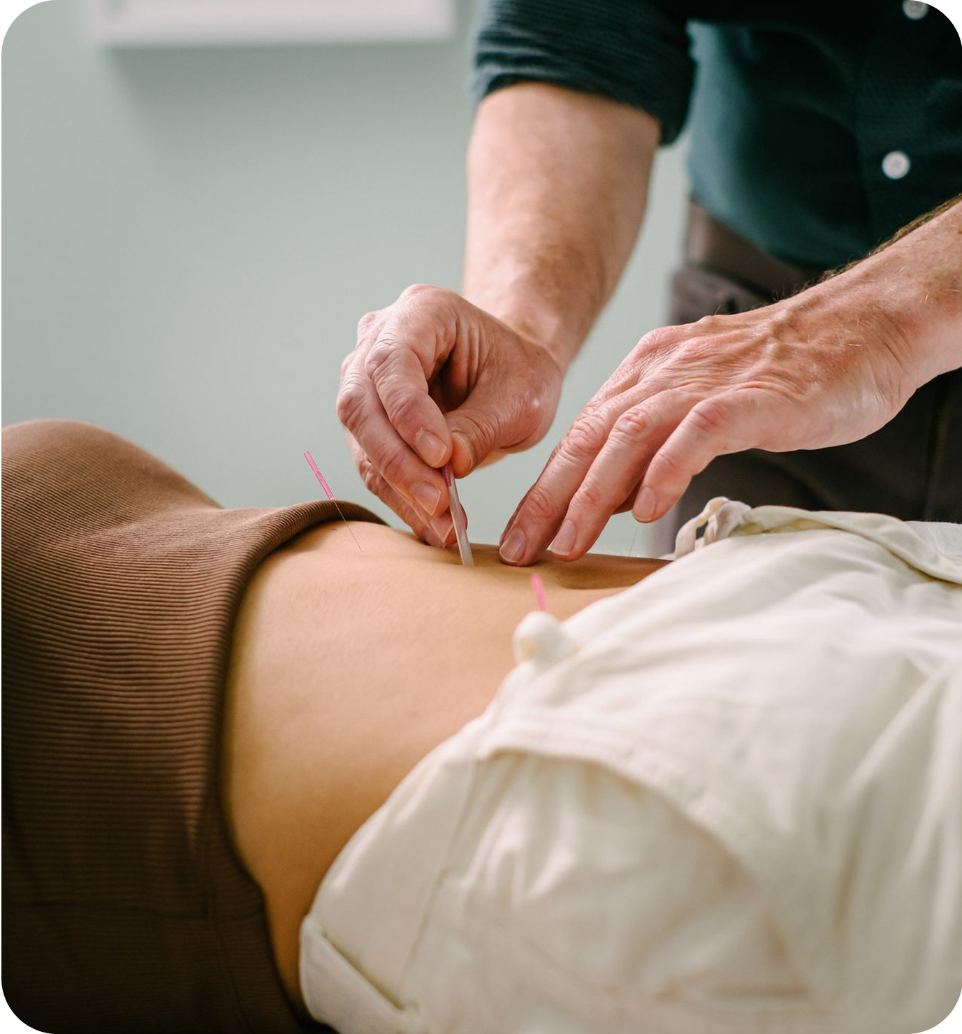 Close-up of an acupuncturist inserting thin needles into a person’s abdomen during an acupuncture treatment.