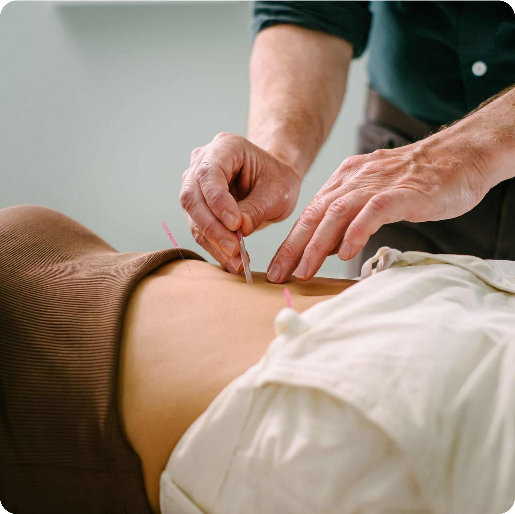 A male practitioner is treating a female patient with acupuncture by inserting fine needles into her abdomen.