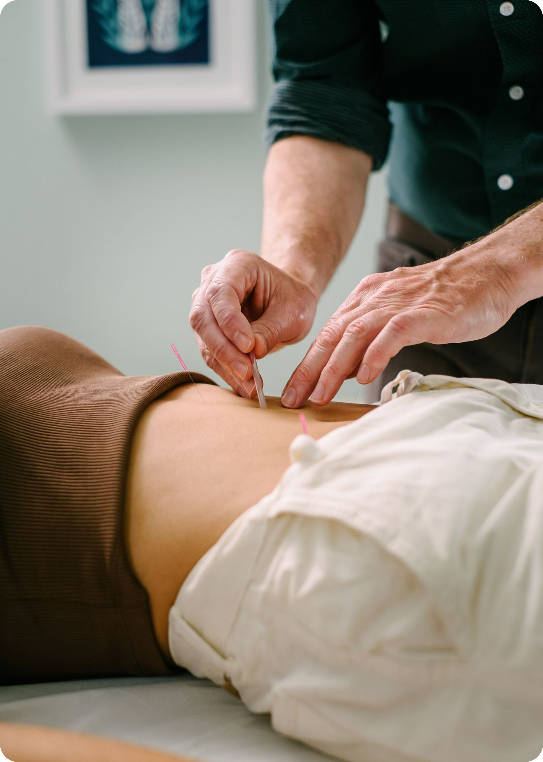 Person receiving acupuncture treatment on their lower back, in a clinic setting.