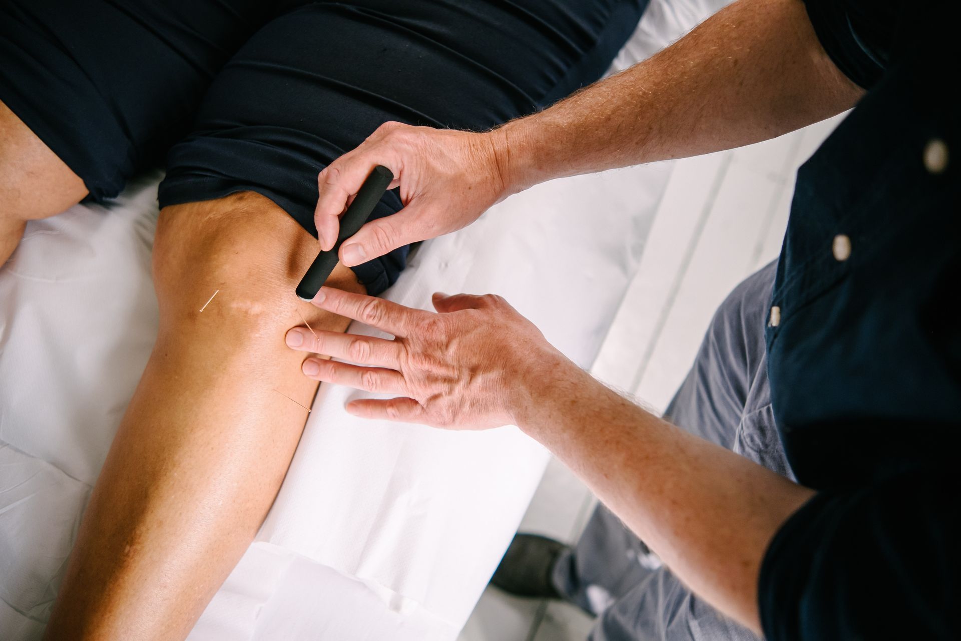 An acupuncturist using moxibustion on a patient's knee.