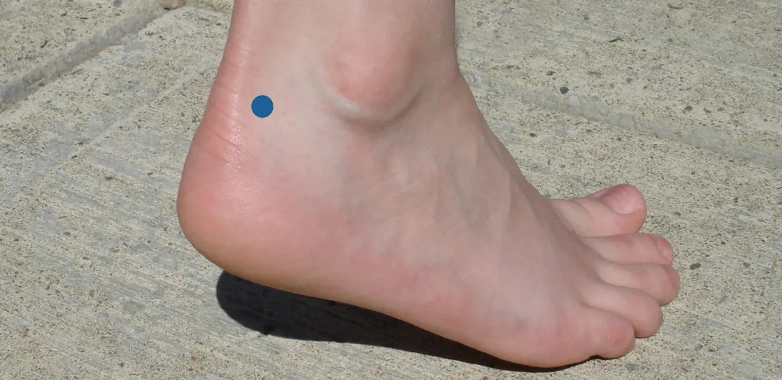 Foot with a blue dot on the outer ankle, resting on a textured gray surface.