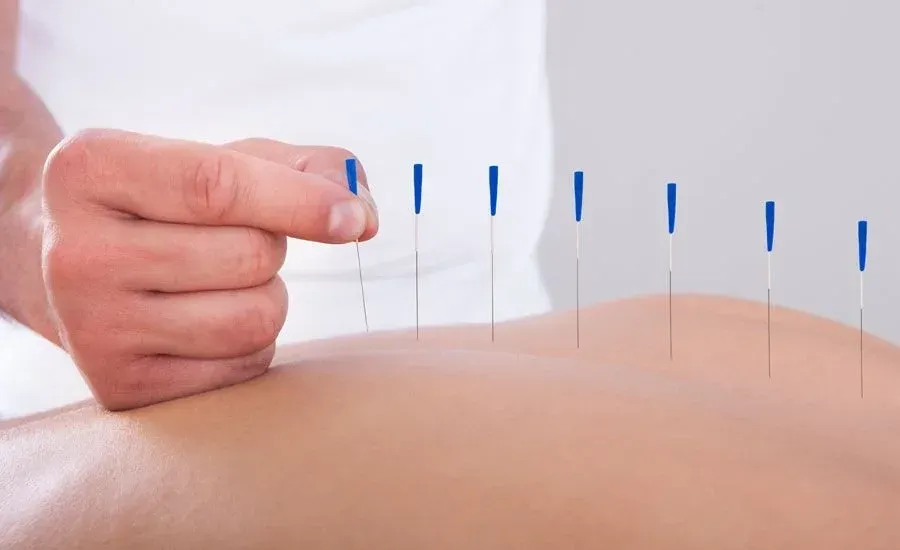 A close-up image of an acupuncturist placing a few needles into the patient's back along the Du Mai channel.