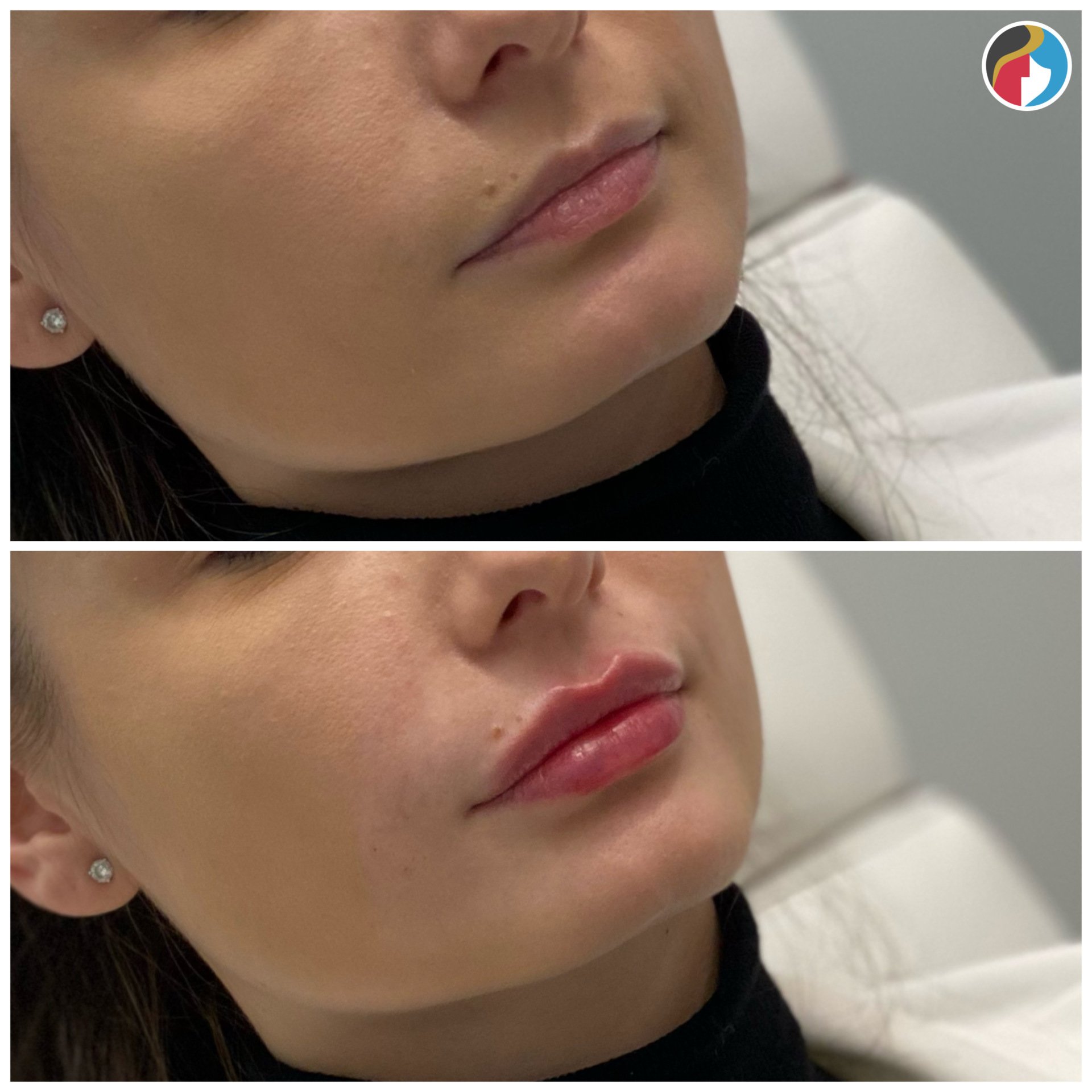 Lip Filler Albany, Syracuse, New Hartford, Utica