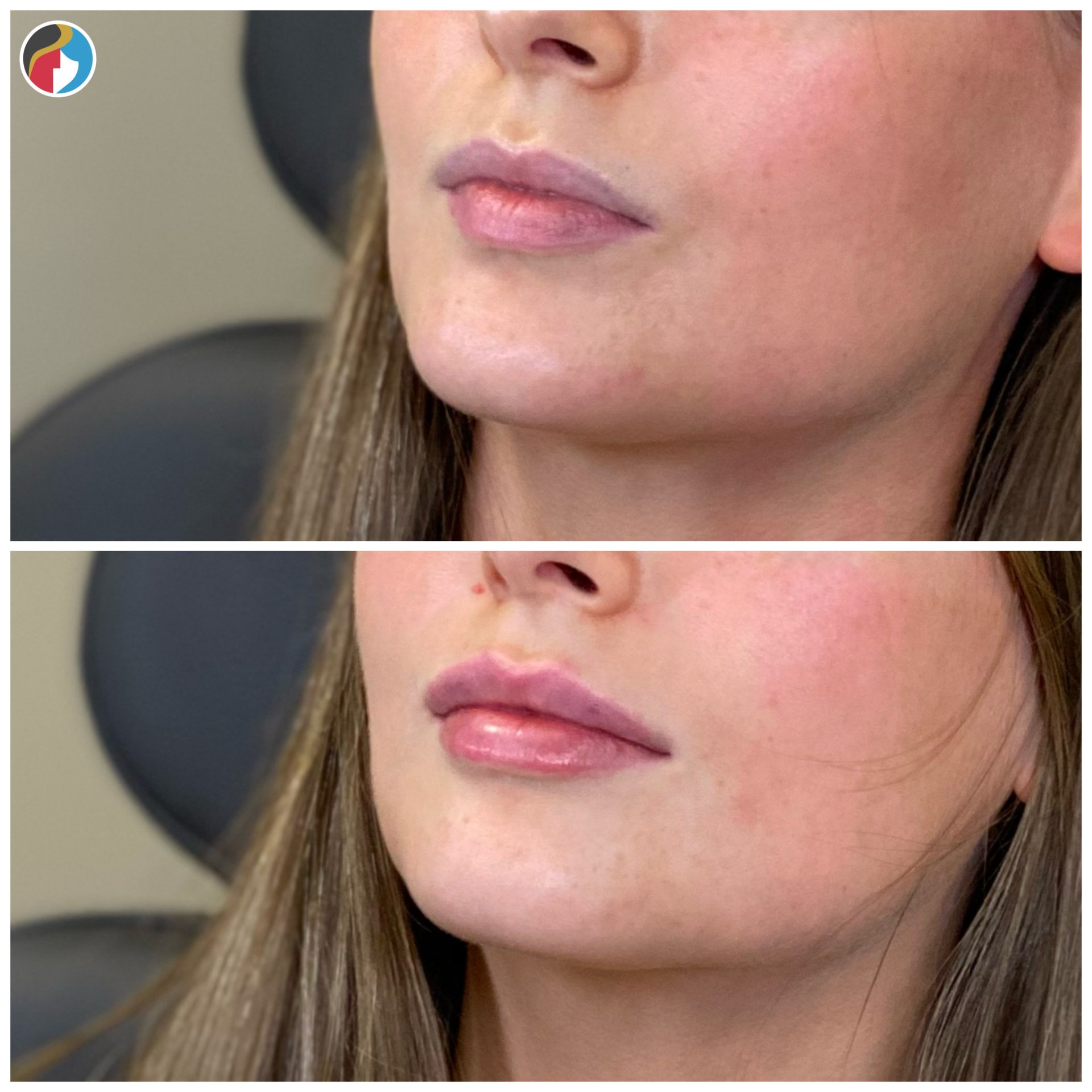 Lip Filler Albany, Syracuse, New Hartford, Utica