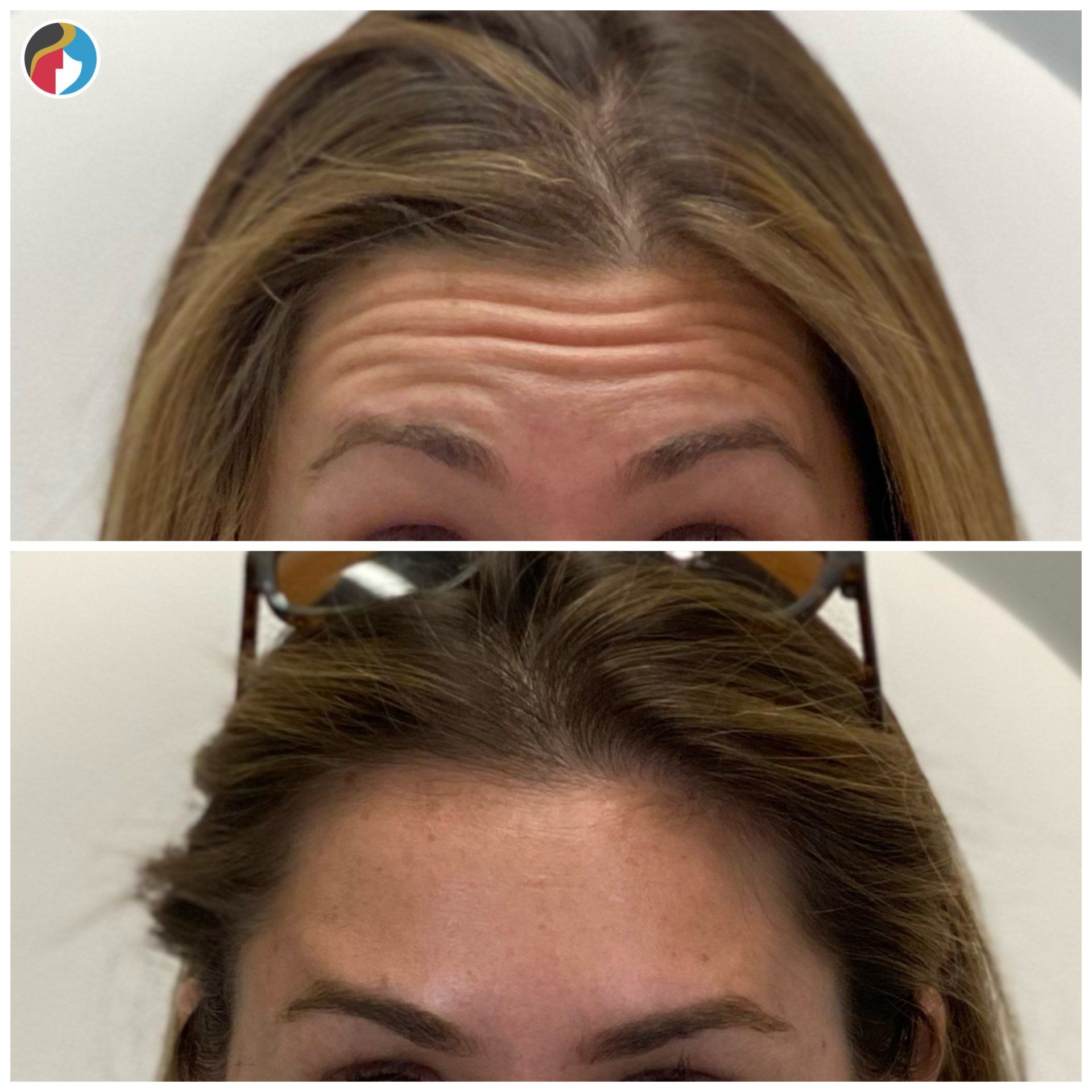 Botox in Syracuse, New Hartford, and Albany, NY