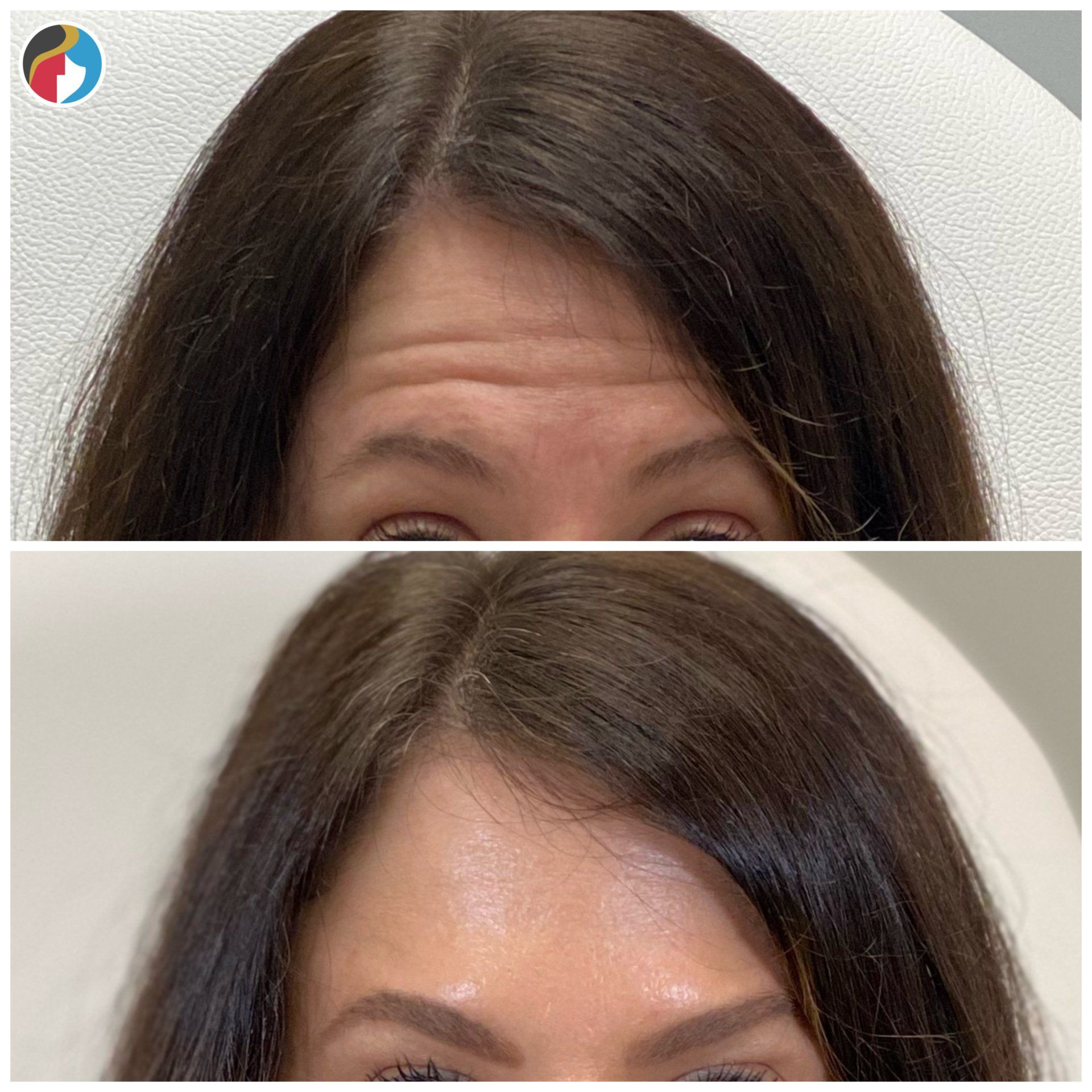 Botox in Syracuse, New Hartford, and Albany, NY