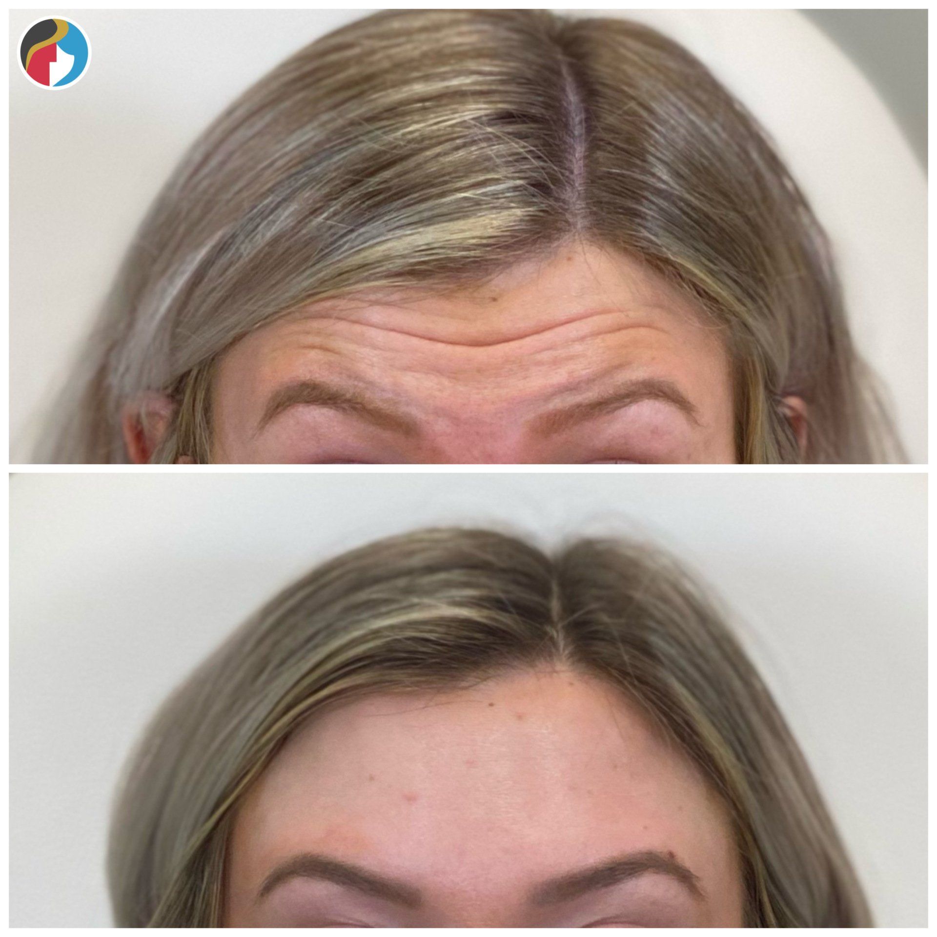 Botox at Rejuvn8