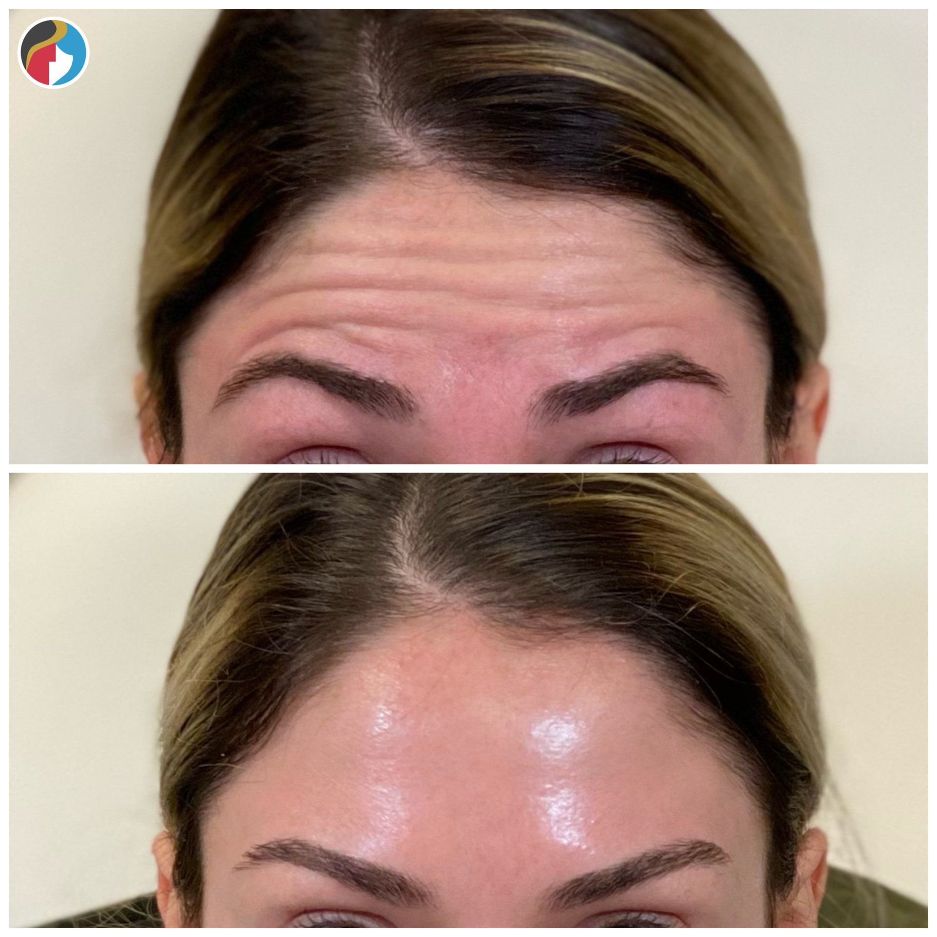 Botox in Syracuse, New Hartford, and Albany, NY