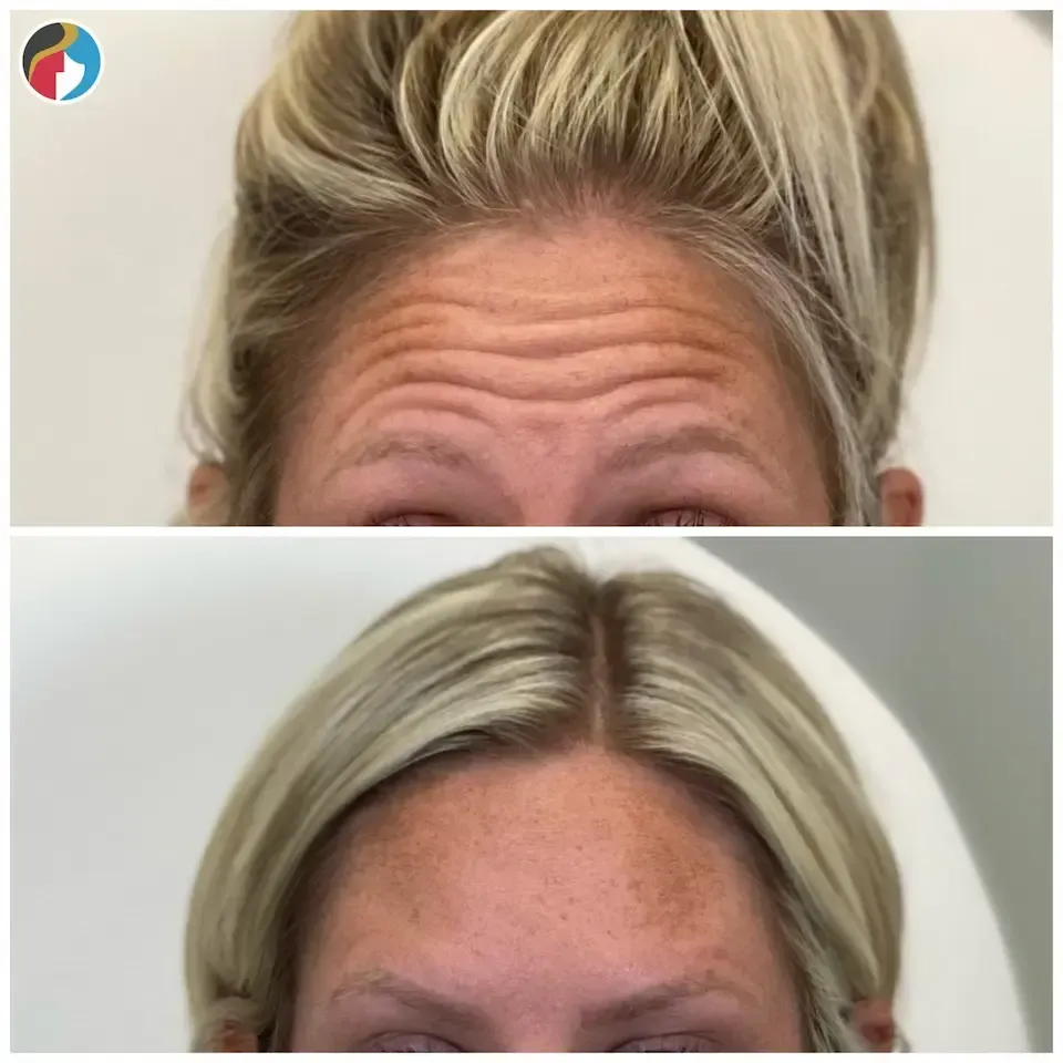 Botox Results Botox in Syracuse, New Hartford, and Albany, NY