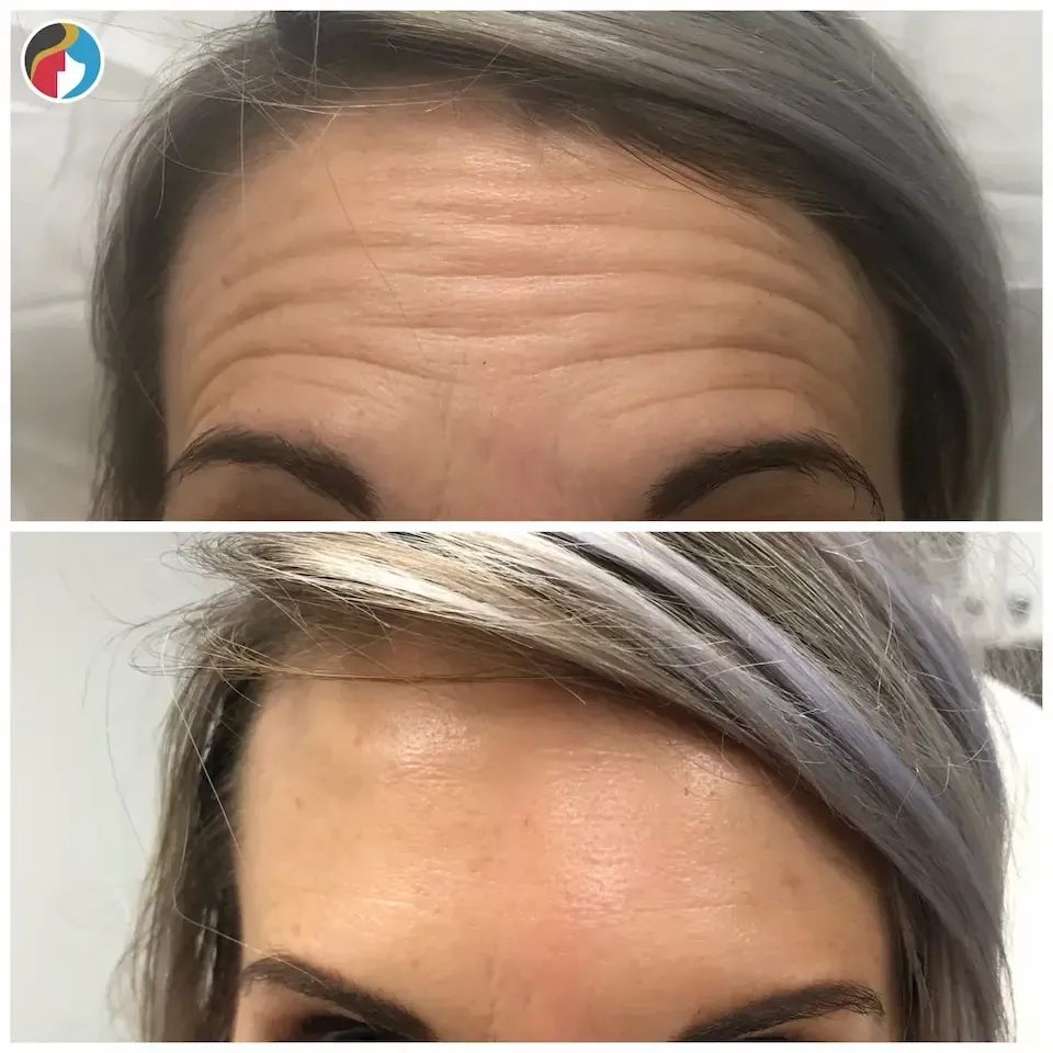 Botox Results Botox in Syracuse, New Hartford, and Albany, NY