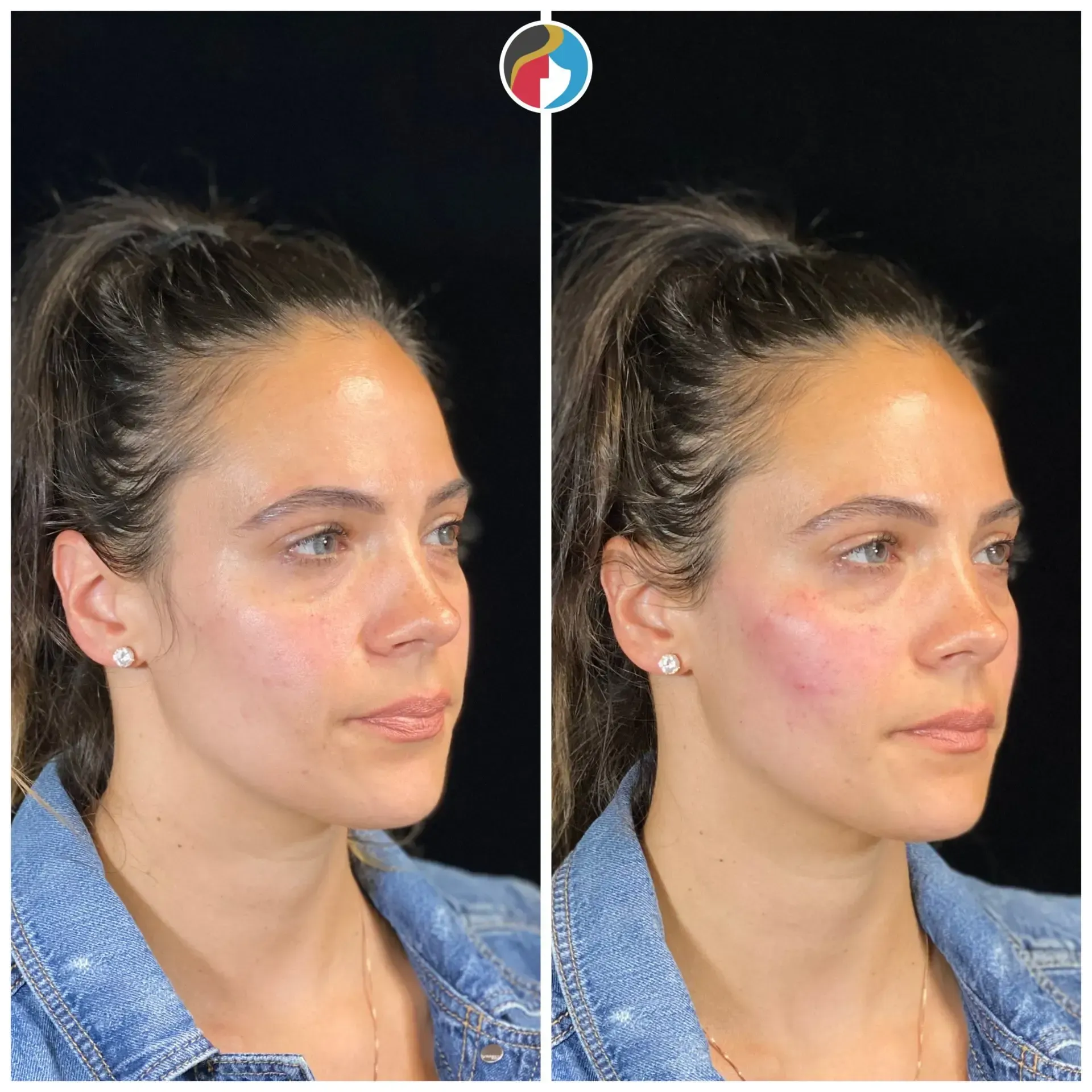 Dermal Filler Results