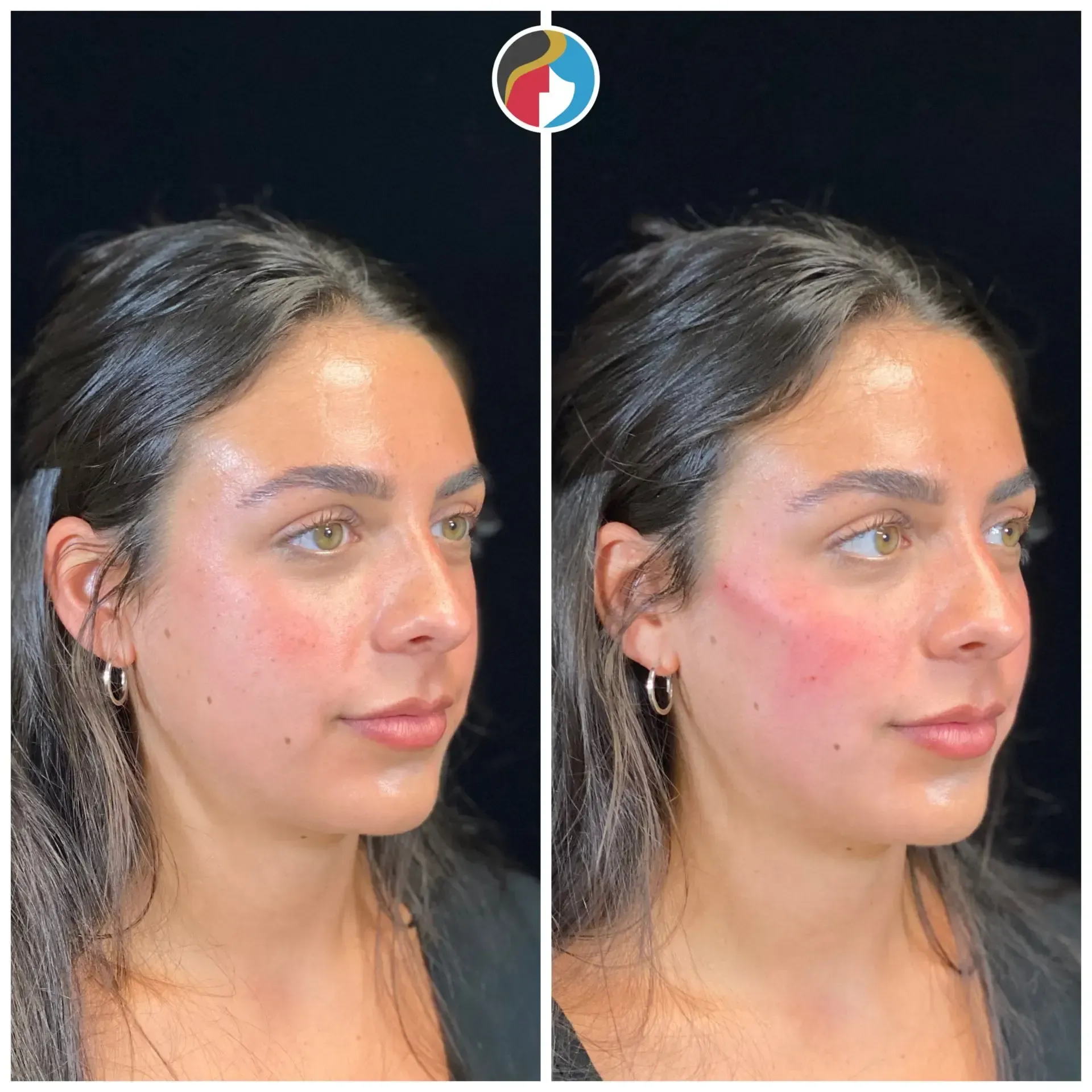 Dermal Filler Results
