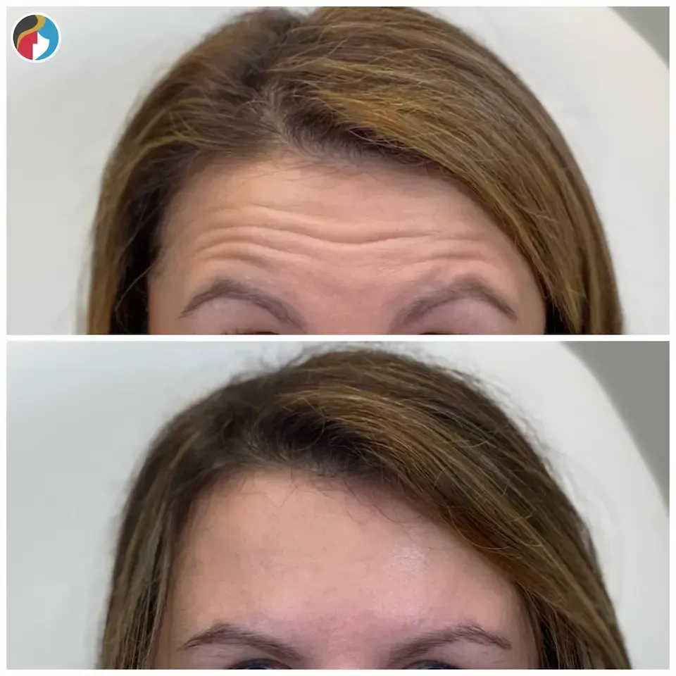 Botox Results Botox in Syracuse, New Hartford, and Albany, NY