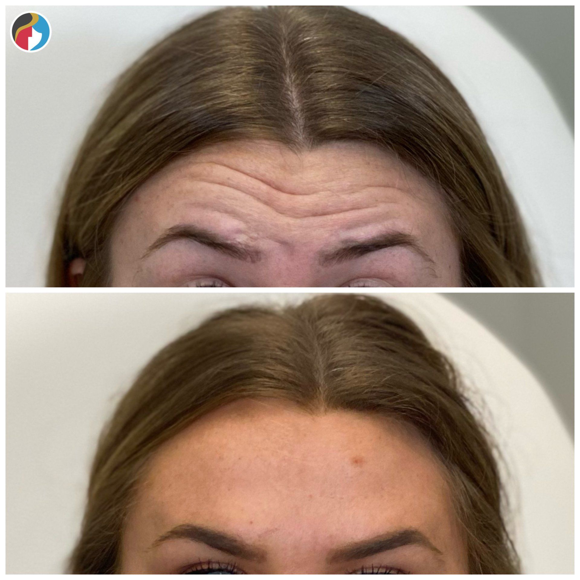 Botox in Syracuse, New Hartford, and Albany, NY