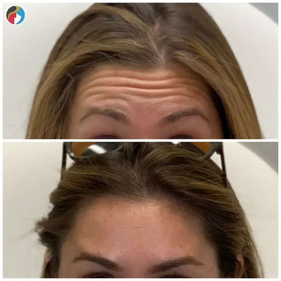 Botox Results Botox in Syracuse, New Hartford, and Albany, NY