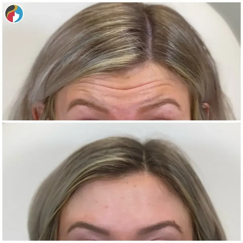 Wrinkle Relaxer Treatment Botox at Rejuvn8