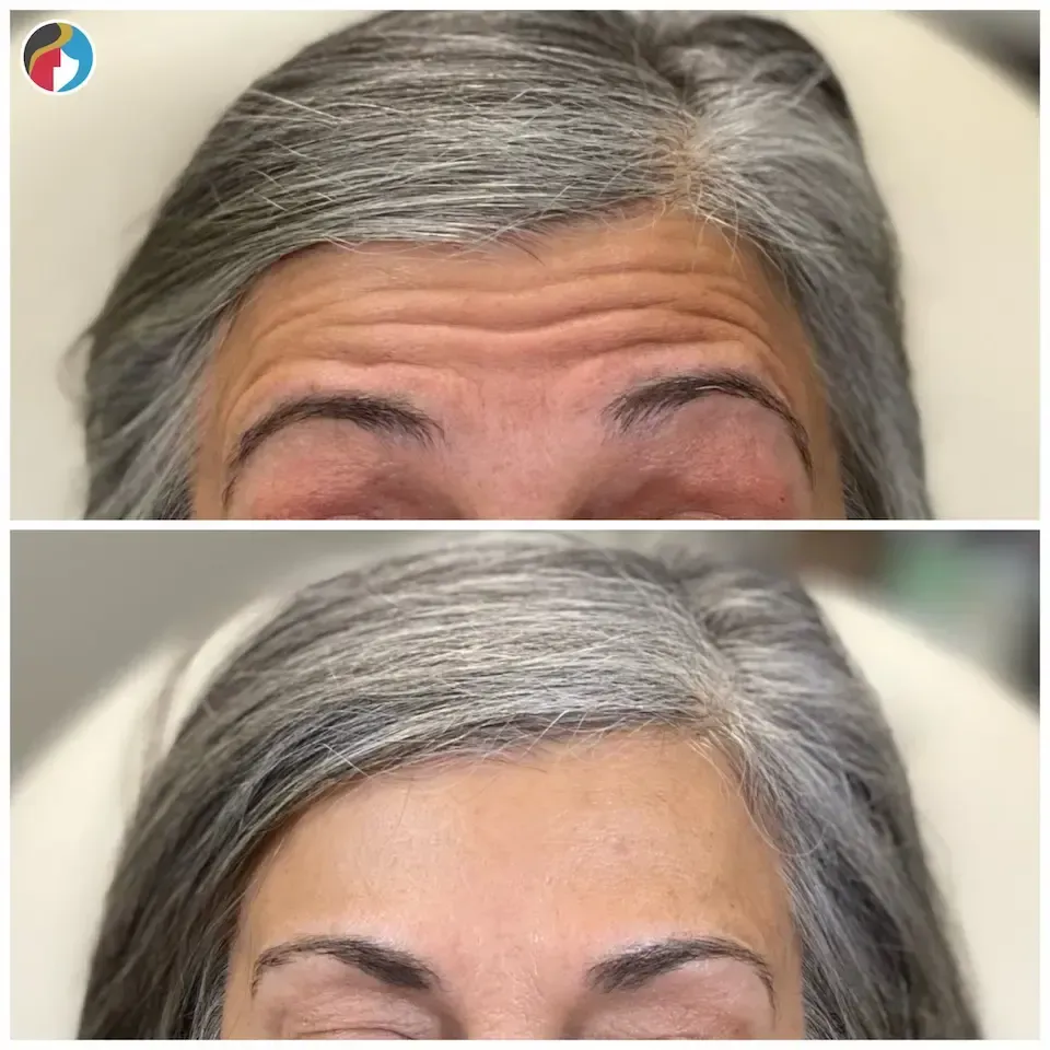 Botox Results Botox in Syracuse, New Hartford, and Albany, NY