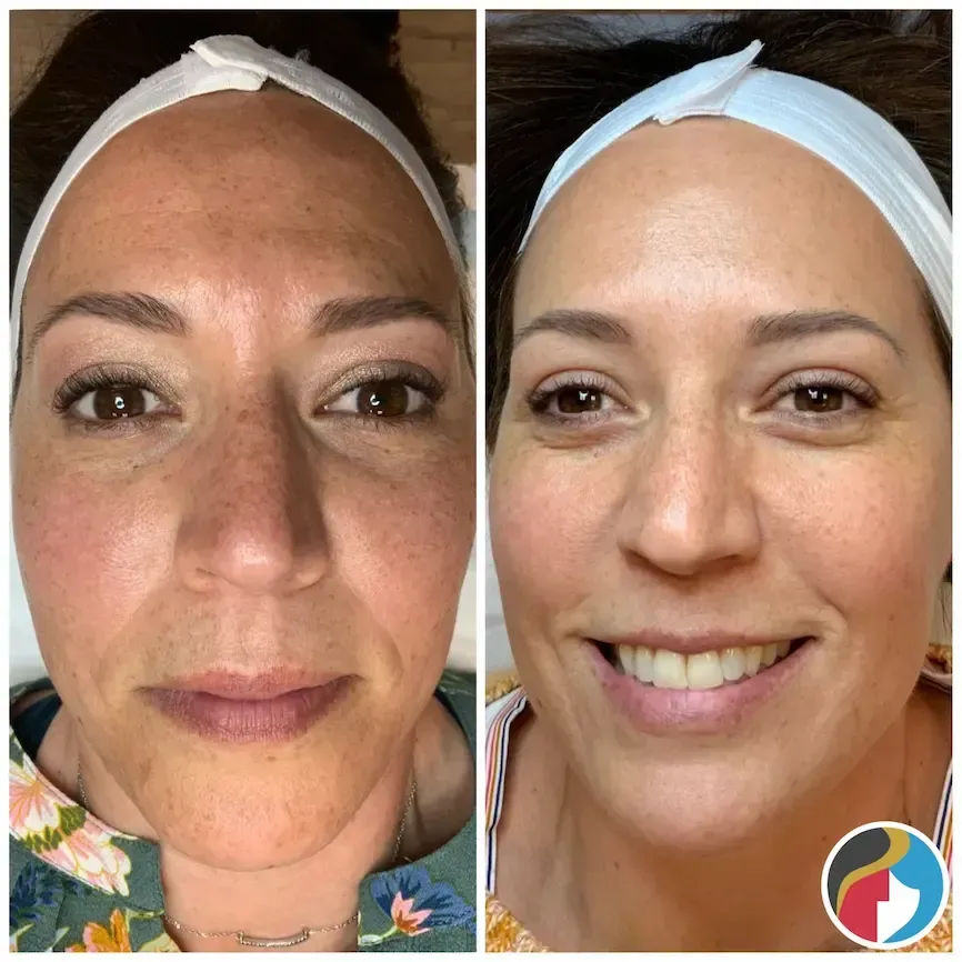 IPL Photofacial Before and After IPL Photofacial Treatment at Rejuvn8