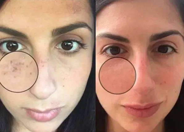 IPL Photofacial Results IPL Photofacial Treatment at Rejuvn8