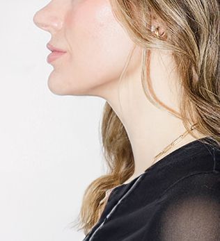 Kybella Woman's profile showing her chin after Kybella treatment in Syracuse at Rejuvn8 Aesthetics.