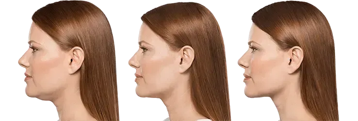 Kybella Treatment Results