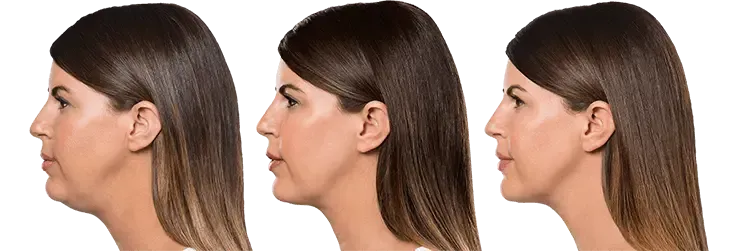 Kybella Treatment Results