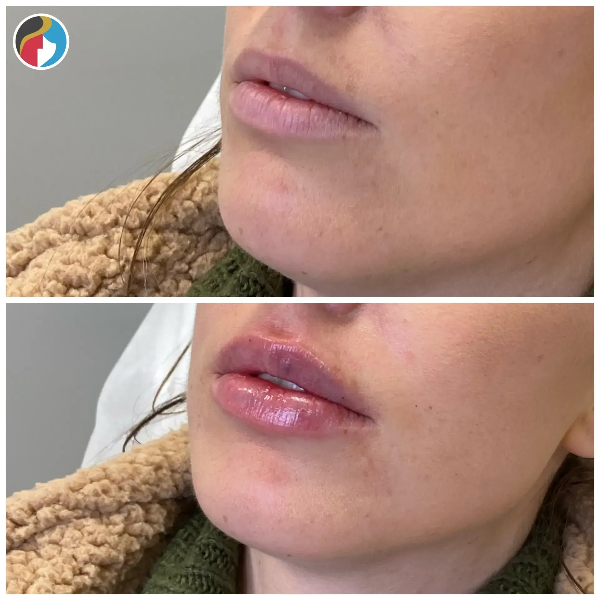 Lip Filler in Syracuse, New Hartford, and Albany, NY