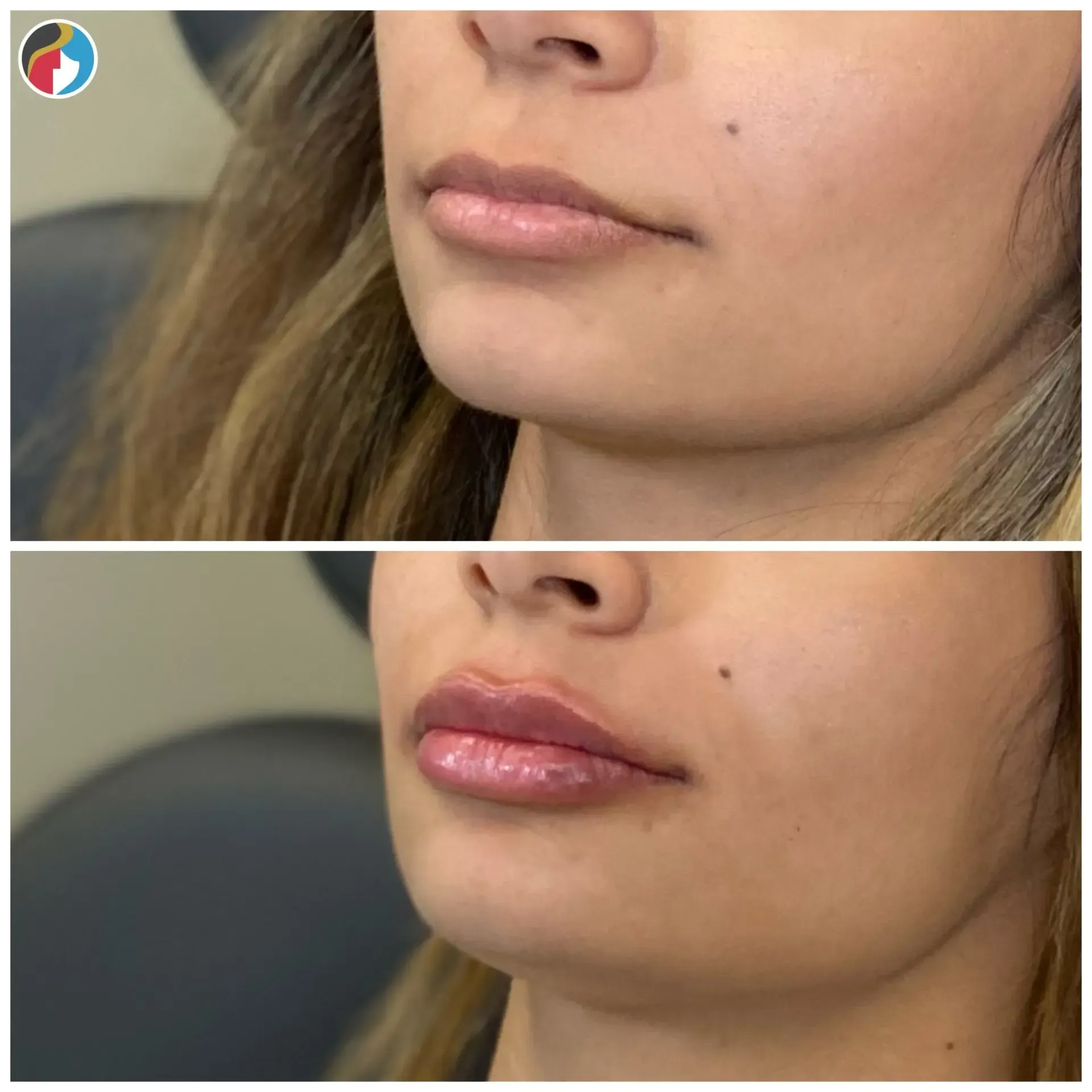Lip Filler in Syracuse, New Hartford, and Albany, NY