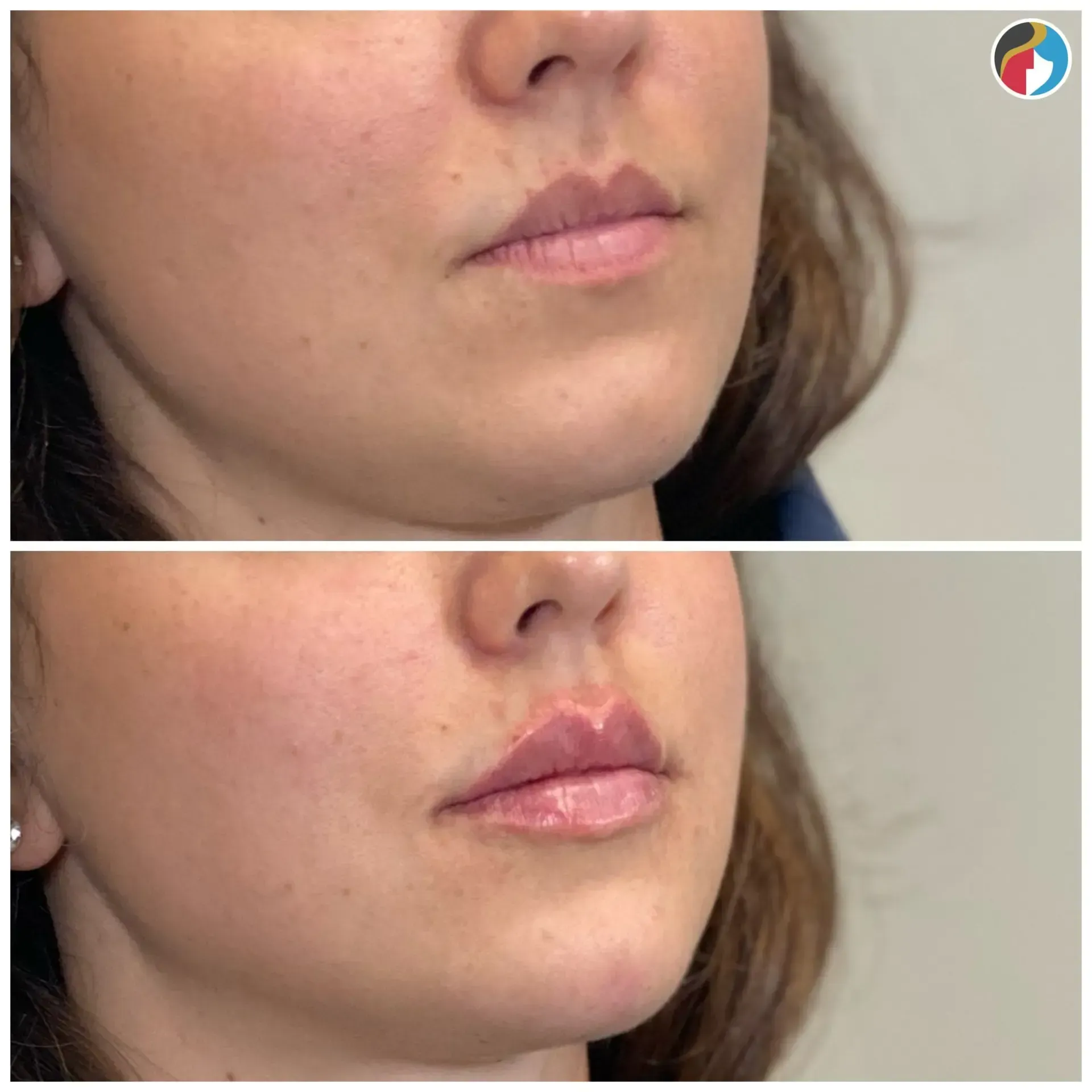 Lip Filler in Syracuse, New Hartford, and Albany, NY