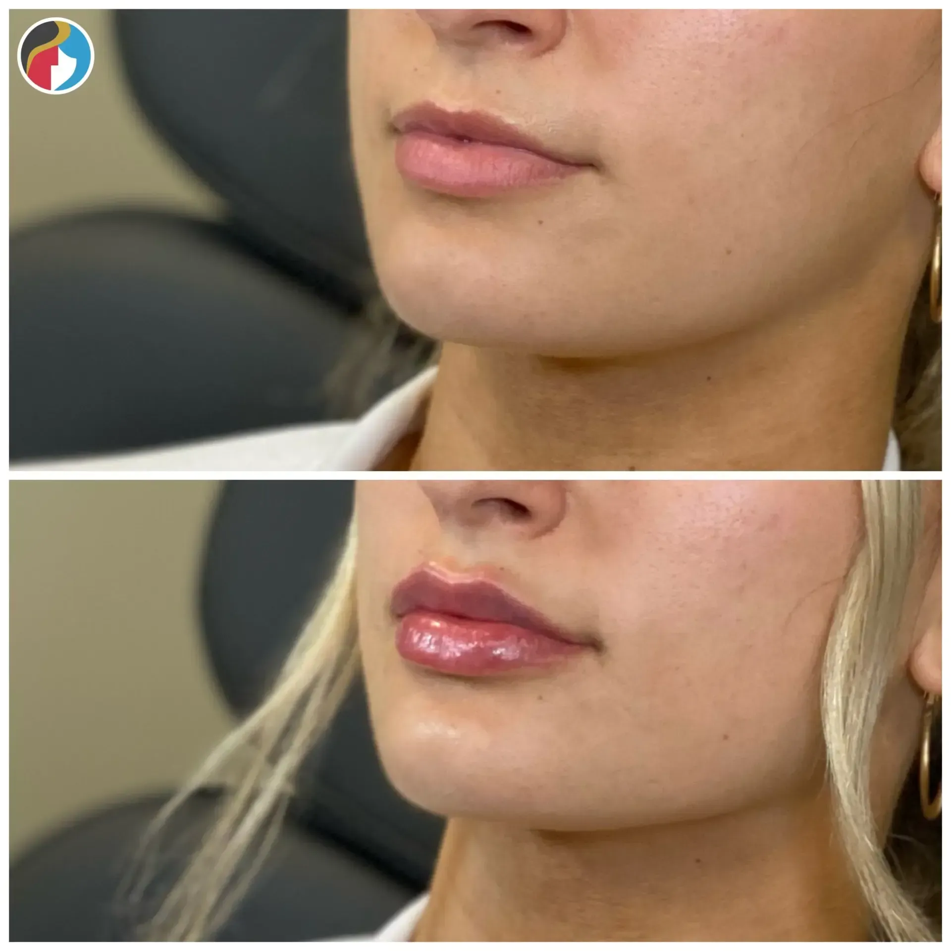 Lip Filler in Syracuse, New Hartford, and Albany, NY
