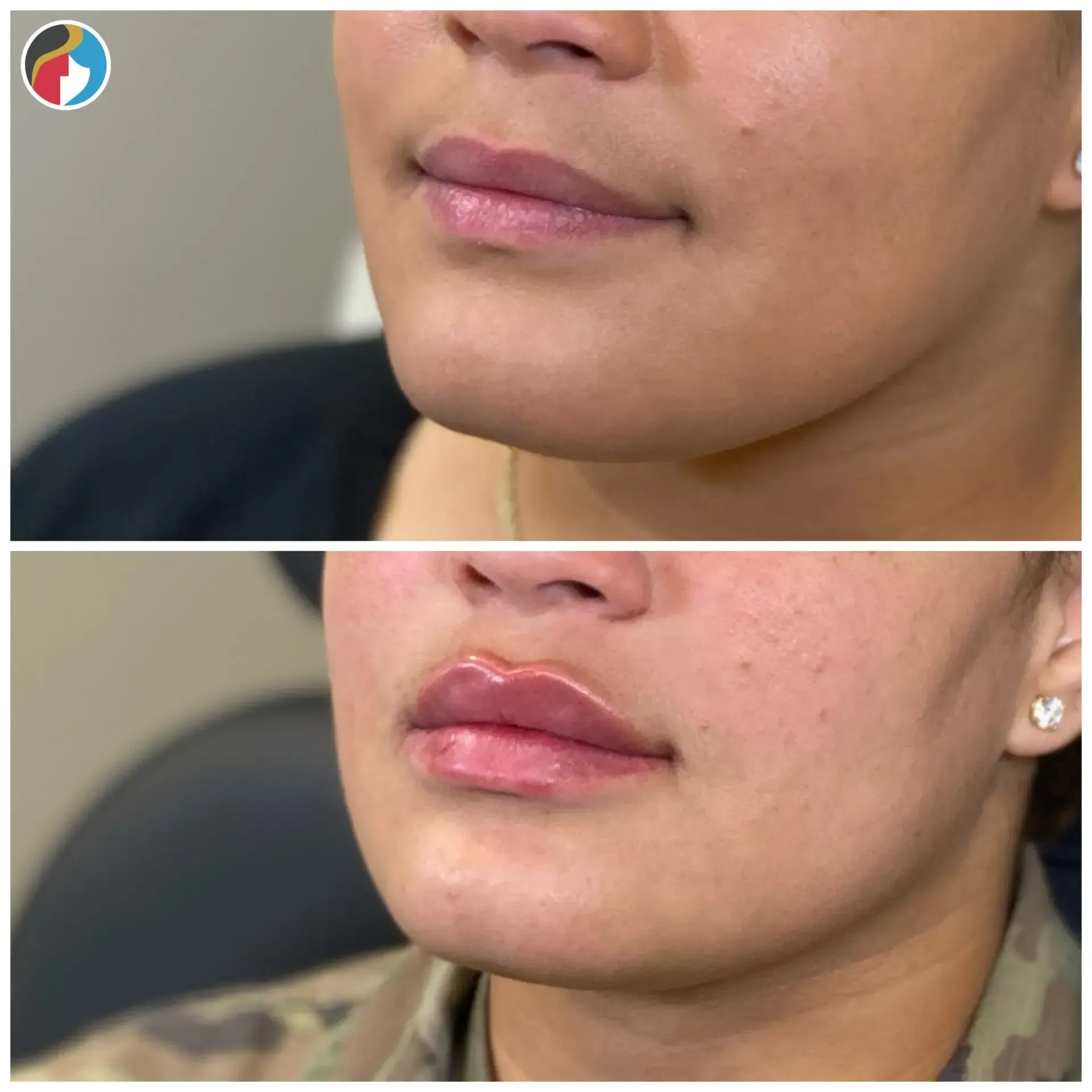 Lip Filler in Syracuse, New Hartford, and Albany, NY