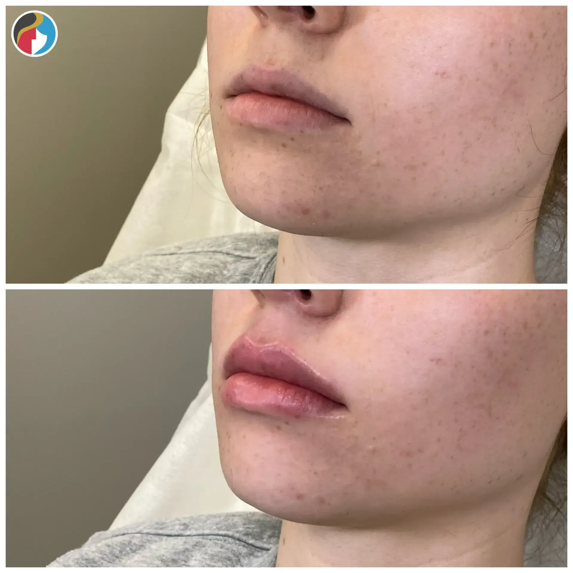 Lip Filler in Syracuse, New Hartford, and Albany, NY