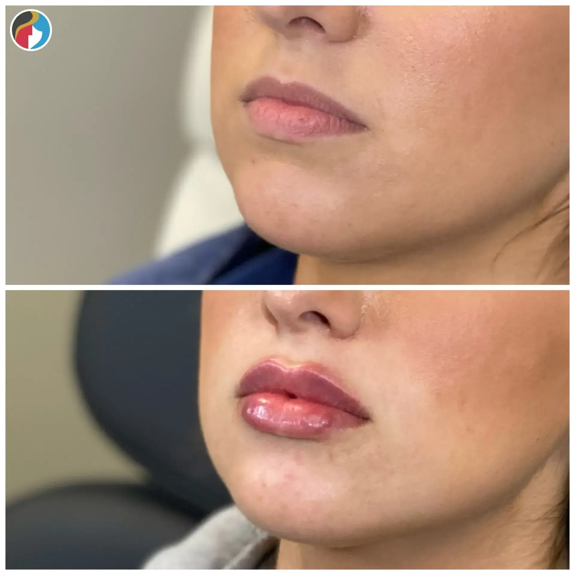 Lip Filler in Syracuse, New Hartford, and Albany, NY