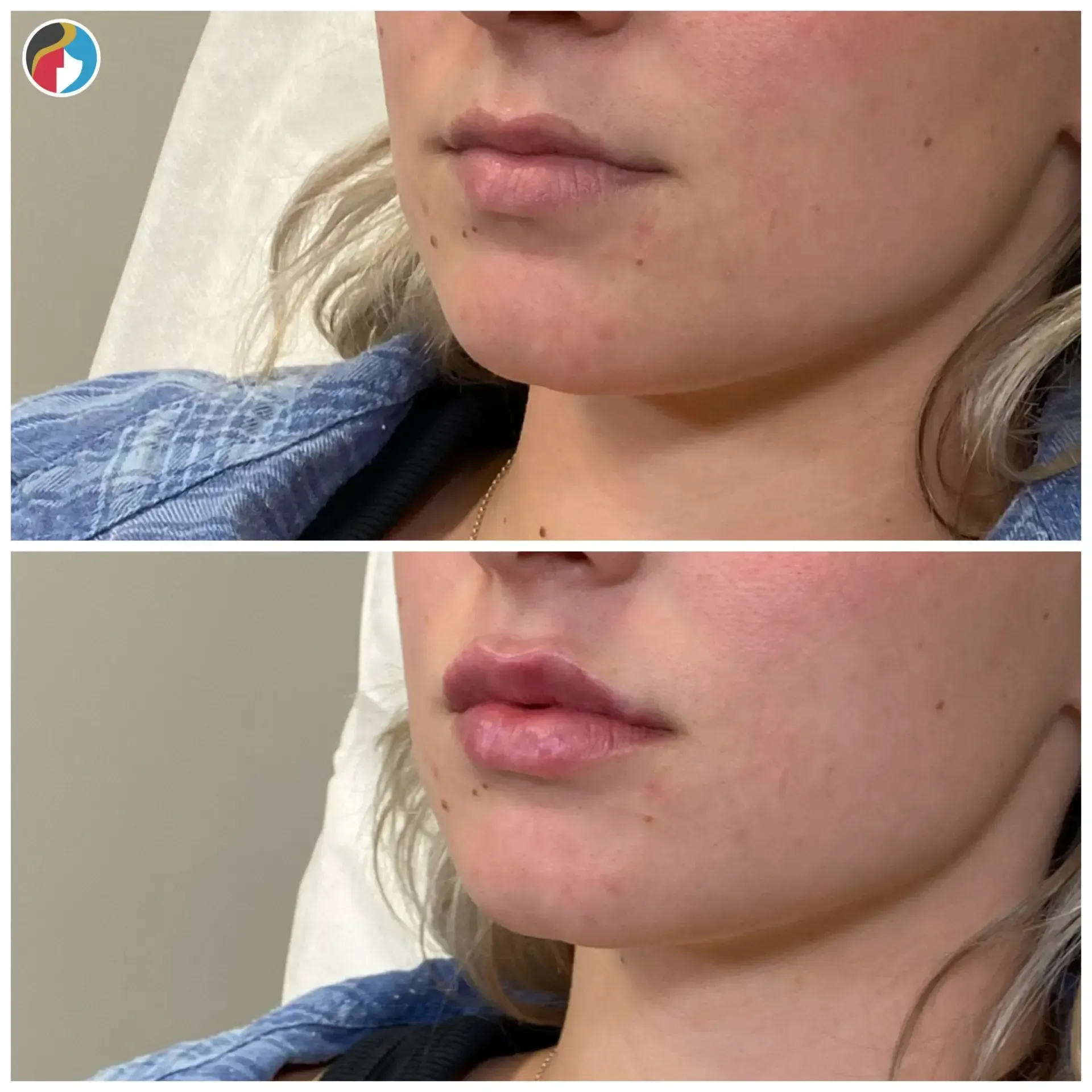 Lip Filler in Syracuse, New Hartford, and Albany, NY