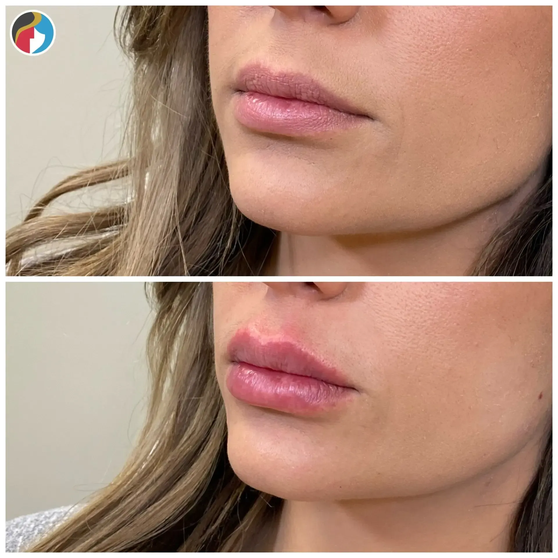 Lip Filler in Syracuse, New Hartford, and Albany, NY