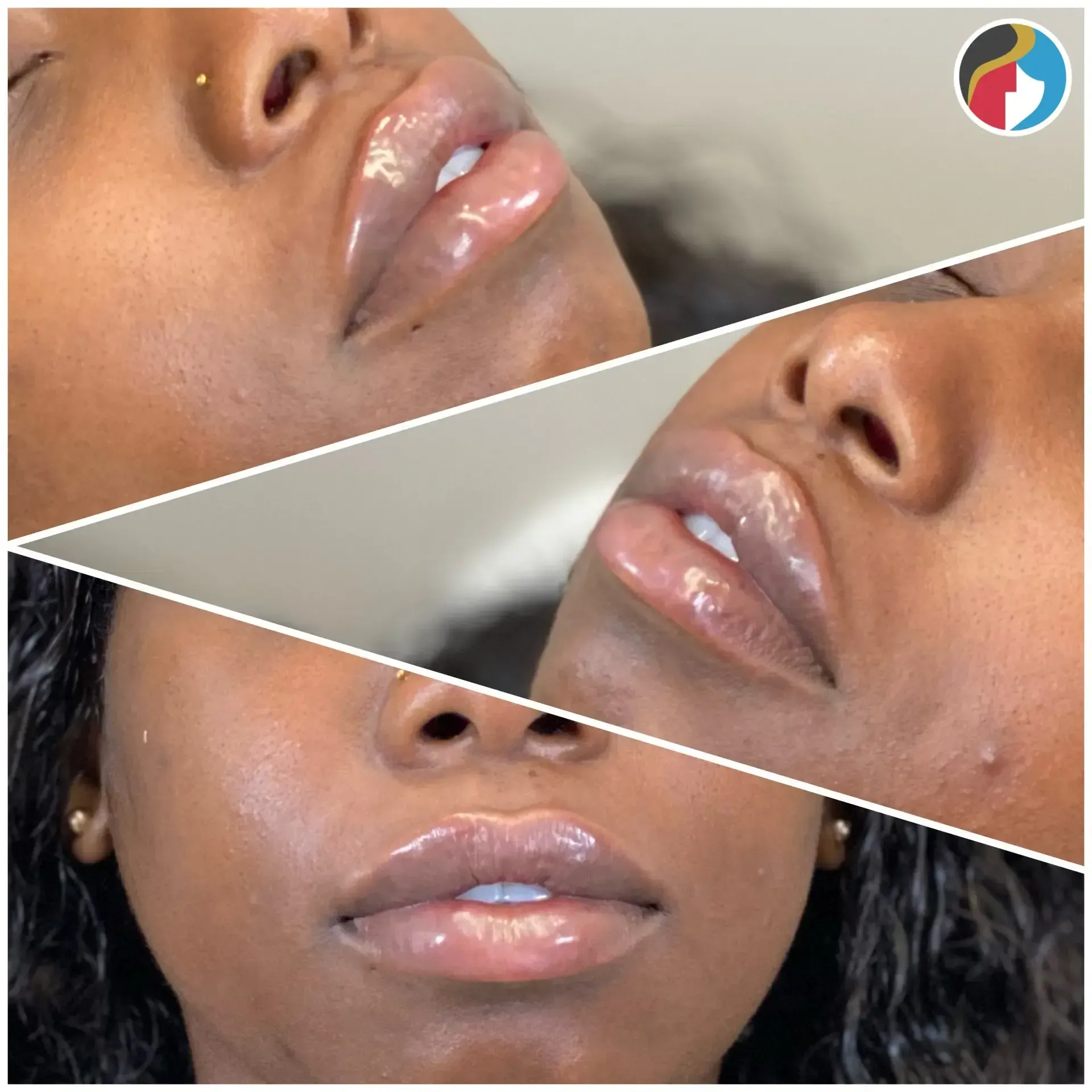 Lip Filler in Syracuse, New Hartford, and Albany, NY