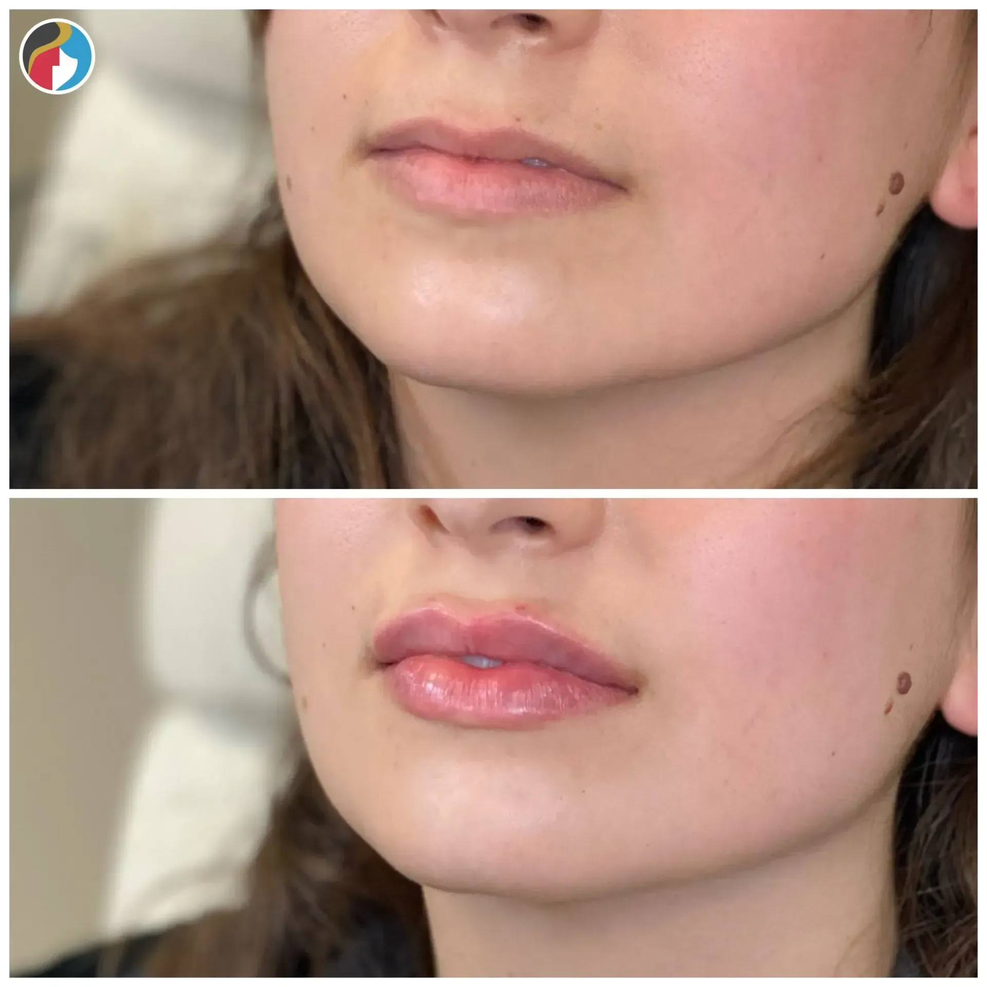 Lip Filler in Syracuse, New Hartford, and Albany, NY